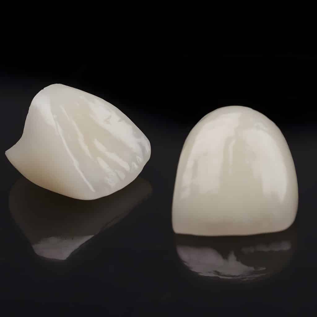 Anterior Crowns Knoxville